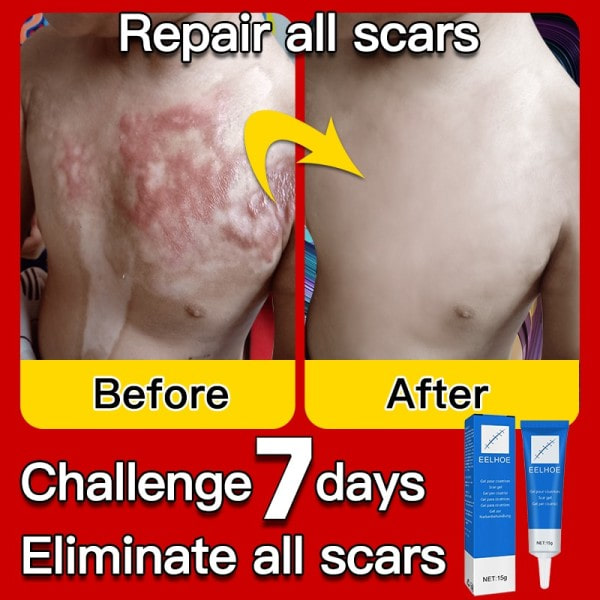 Ar fjernelse creme gel fjern acne pletter behandling stræk mærker forbrænding kirurgi ar reparation creme