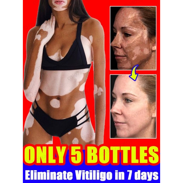 Urte ekstrakt vitiligo salve fjern ringorm hvid pletter fjernelse