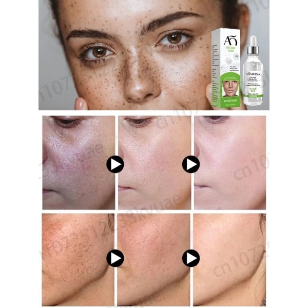 Fregner creme fjerner fregner chloasma mørke pletter pigmentering alder pletter og pletter