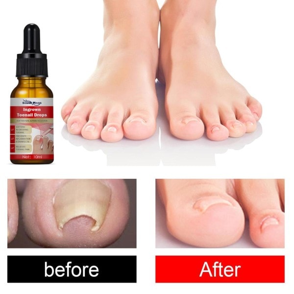 Tånagel behandling serum nagel korrigering återhämtning olja smärtstillande nagel mjukmedel trimma med lätt olja fötter