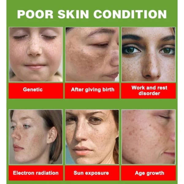 Fregner fjernelse essens fjern ansigtsbehandling pletter hud mørk plet fjern melasma pletter solpletter hvidning og fregne fjernelse creme