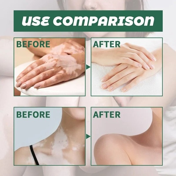 Effektivt vitiligo reparation salve urte fjernelse ringorm hvid plet creme fjern få kvit af hud