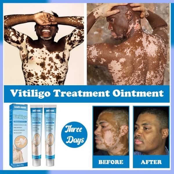Urte ekstrakt vitiligo salve fjern ringorm hvite flekker fjerning leukoplakia behandling krem