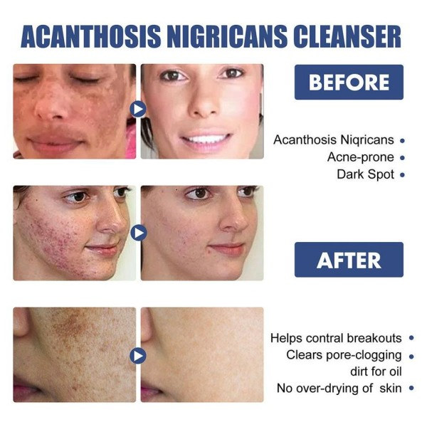 Whitening Facial Cleanser Brighten Hud Tone Forfriskende Fade Spot Chloasma Fjernelse