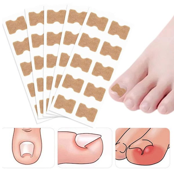 Nail Correction Stickers, 10 Pcs Glue Free Toenail Toe Ingrown Nail Correction Patch Nail Sticker Foot Care