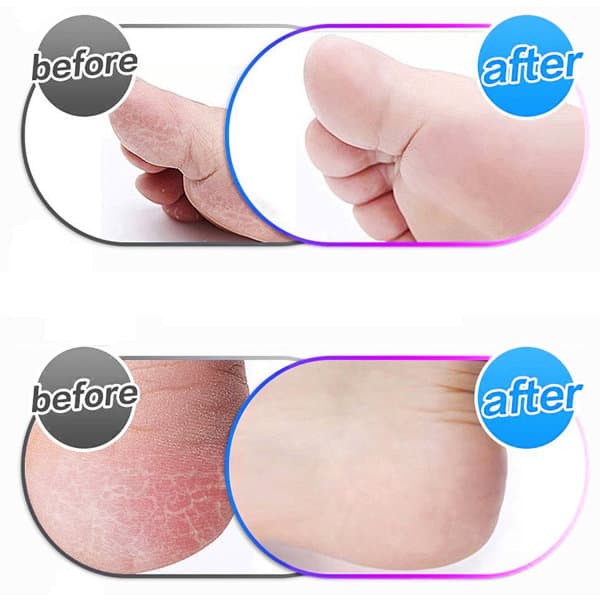 10-pak rullerhoder kompatible med Emjoi Micro Pedi Nano, utskiftning
