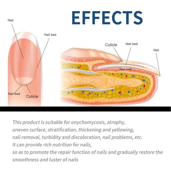 2 kartonger Nagelreparationsplåster Antifungal Nagelplåster Svamp - on stock