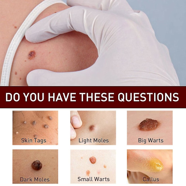 Jaysuing Verruca Removing Liquid Pen för Nevus Care Pen för Verruca Removing Sharp Verruca, Barb Removing Filamentous Verruca, Spot Nevus Removing Pen