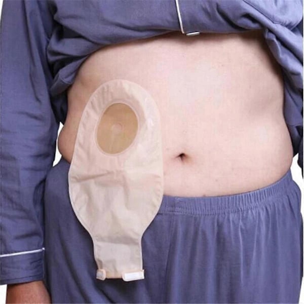 5 kpl avannepusseja, yksiosaisia tyhjennettäviä pusseja kolostomiaan, ileostomiaan ja avannehoitoon, 20–60 mm tyhjennysventtiili, kolostomiapussit