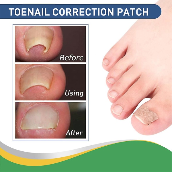 Fungal Nail Treatment Patch, Nail Repair Patches Fungal Nail Repair Treatment, Repair Onychomycosis Fungal Nail Patches