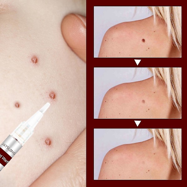 Jaysuing Verruca Removing Liquid Pen för Nevus Care Pen för Verruca Removing Sharp Verruca, Barb Removing Filamentous Verruca, Spot Nevus Removing Pen