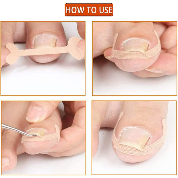 40 st inåtväxta tånagelkorrigerande klistermärken Andas självhäftande elastiskt tånagelkorrigeringsplåster