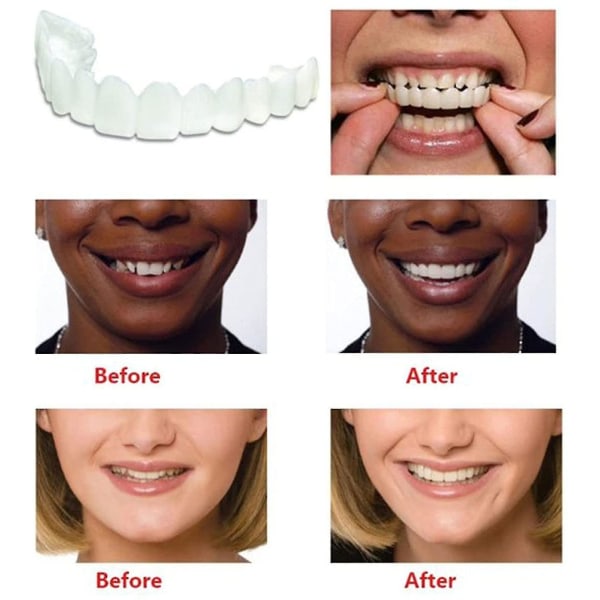 Snap On Teeth Veneers, perfekte midlertidige erstatninger for tenner