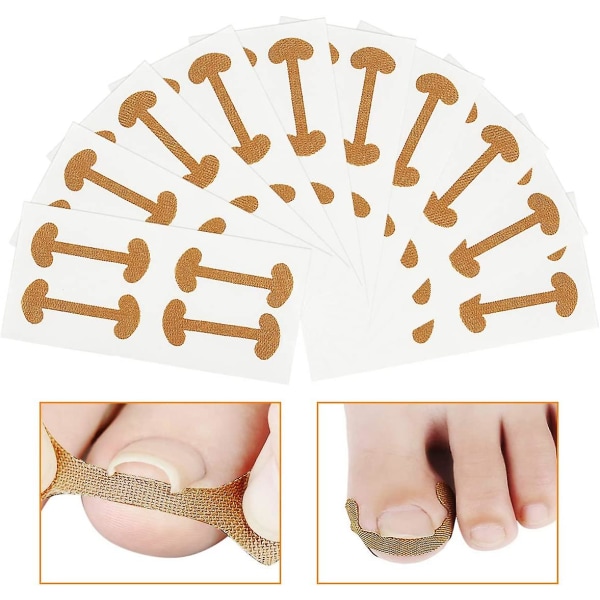 40 st inåtväxta tånagelkorrigerande klistermärken Andas självhäftande elastiskt tånagelkorrigeringsplåster