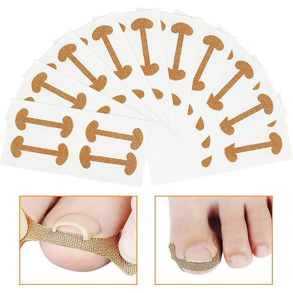 40 st Ingrown tånagel korrigering klistermärken andningsbar självhäftande elastisk tånagel korrigering lapp