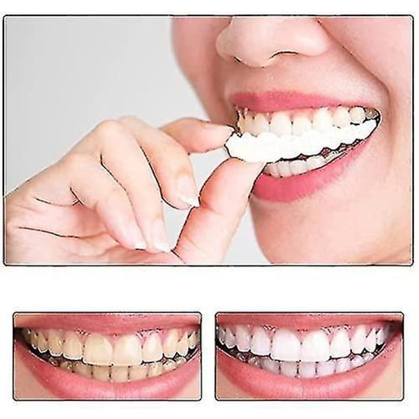 Snap On Teeth Veneers, perfekte midlertidige erstatninger for tenner