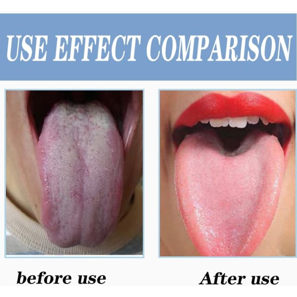 Blue Tongue Cleaner, ruostumattomasta teräksestä valmistettu kielenpuhdistusaine, poista huono B