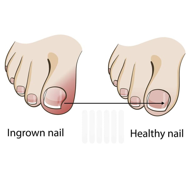10 stk Inngrodd tånegl Pedikyrverktøy Retting Klips Buet Brace Tånegler Tykk Paronychia Korreksjonsverktøy Fot-