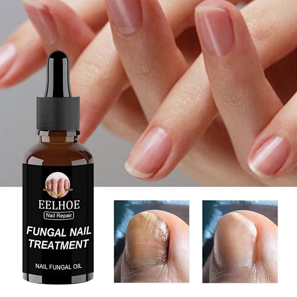 50ml EELHOE Nagelvårdslösning För Förtjockning Och Uppljusning Av Naglar Tar Bort Grå Och Döda A1X5 brownA 30ml