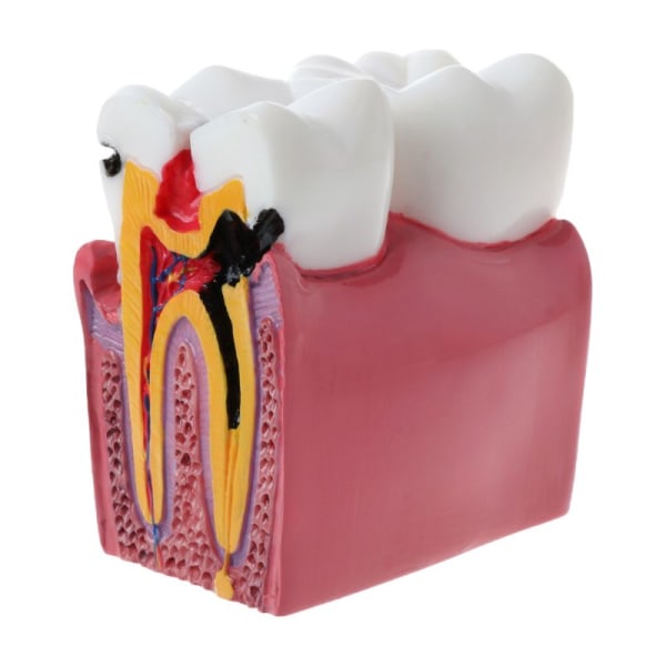 6 gånger Dental Caries Jämförelse Anatomi Tänder Modell för Dental Anatomy Lab Tea