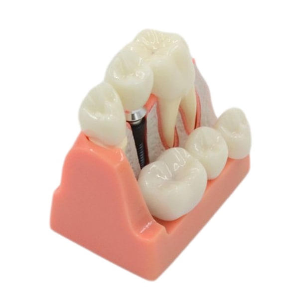 Dental Teach Implant Analysis Crown Bridge Avtagbar Dental Demonstration Tänder Modell för läkare-patientkommunikation