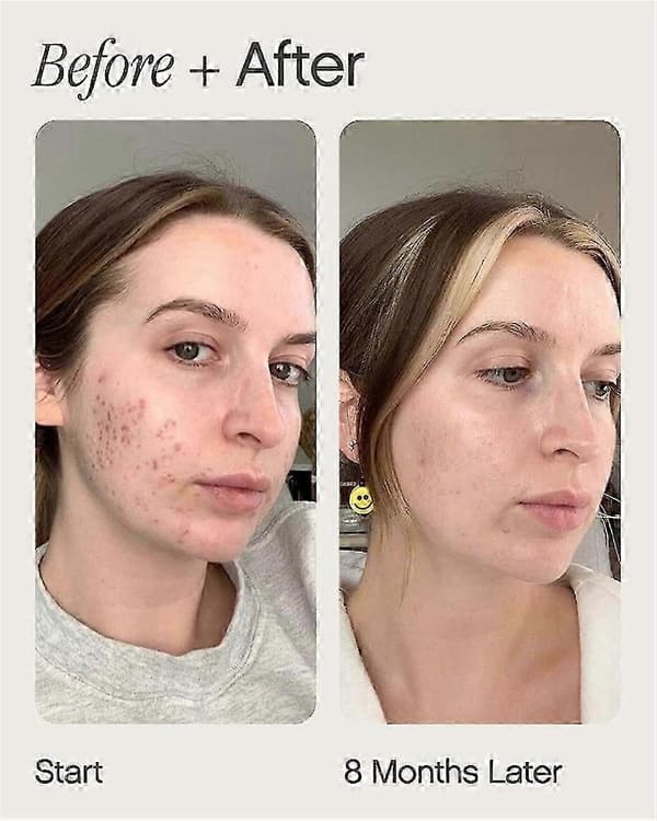 Bleget topisk Barsinfi lysnende og rensende serum 1 pc