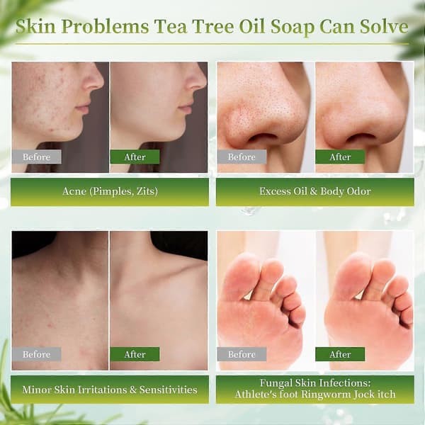 3 st Tea Tree Svampdödande Tvål, Naturlig Tea Tree Olja Tvål för Ansikte Kropp Händer
