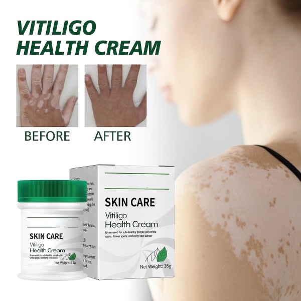 SQBB Vitiligo Cream, Vitiligo Treatment kompatibel Skin Vitiligo, Vitiligo Health Cream kompatibel Minska vita fläckar Förbättra hudpigmentering-E.