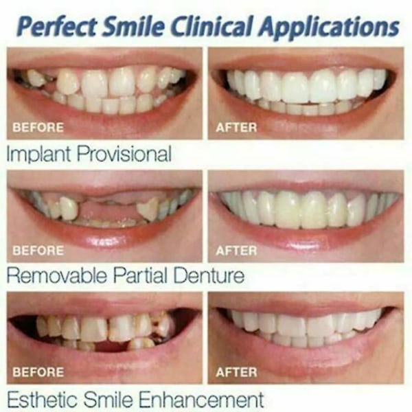 SQBB Perfekt Smile Brace Fast på øvre falske tænder Dental Faner Protes Cover Set null none