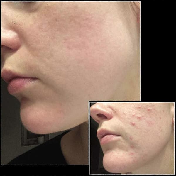 Microneedle Derma Stamp til ansigtshud, arreparation efter akne og hårvækst [YJD]