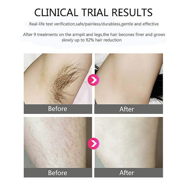 999999 Flash Ipl Laser Permanent Hårfjerning Laser Epilator Til Kvinder