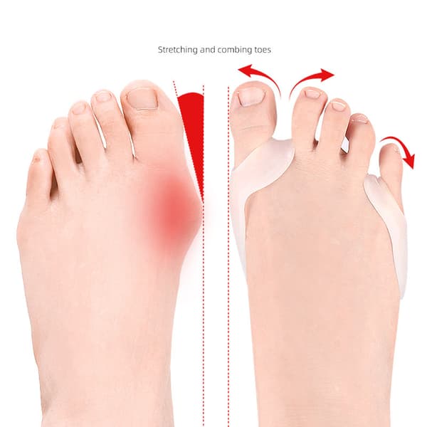 Tåsträckare, Bunion Corrector för stortån