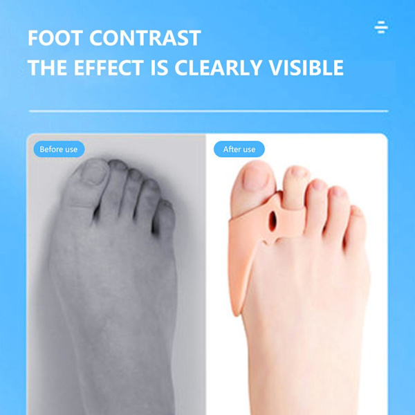 2 Par Tåseparatorer Tåavstånd Bunionkorrigerare Silikon Ortos Bunion Relief för Bunion Överlappning