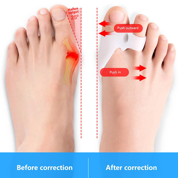 2 Par Tåseparatorer Tåavstånd Bunionkorrigerare Silikon Ortos Bunion Relief för Bunion Överlappning