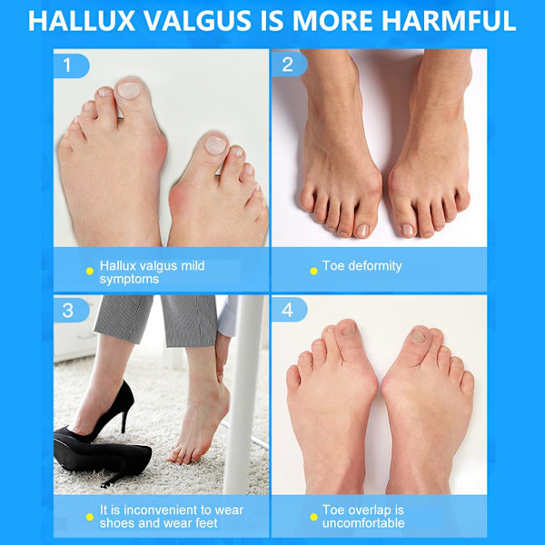 2 Par Tåseparatorer Tåavstånd Bunionkorrigerare Silikon Ortos Bunion Relief för Bunion Överlappning