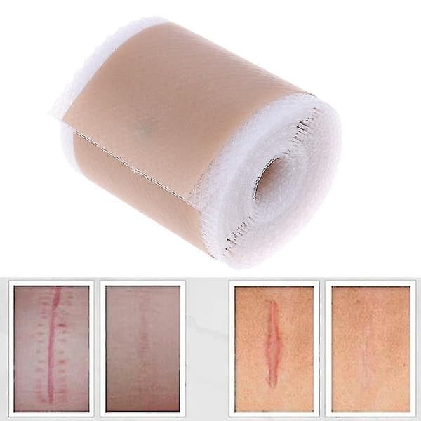 Ny silikongel arrfjerningsark terapi patch for akne traume brannskade hud, 4cm*1.5m