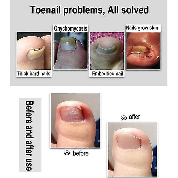 Tånagelklippare Set Tjocka inåtväxta tånaglar Precisionsnagelverktyg Saxsvart Black
