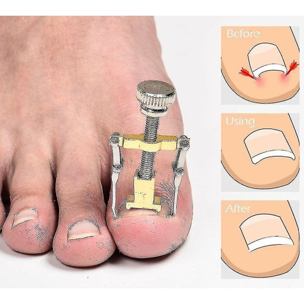 Indgroede tånegle Manicure Pedicure Fodpleje Korrektion Brace Tool Toe Clipper