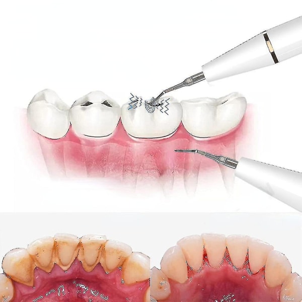 Plackborttagare för tänder Tandrengöringssats för borttagning av matrester tandsten Munvård hemma White