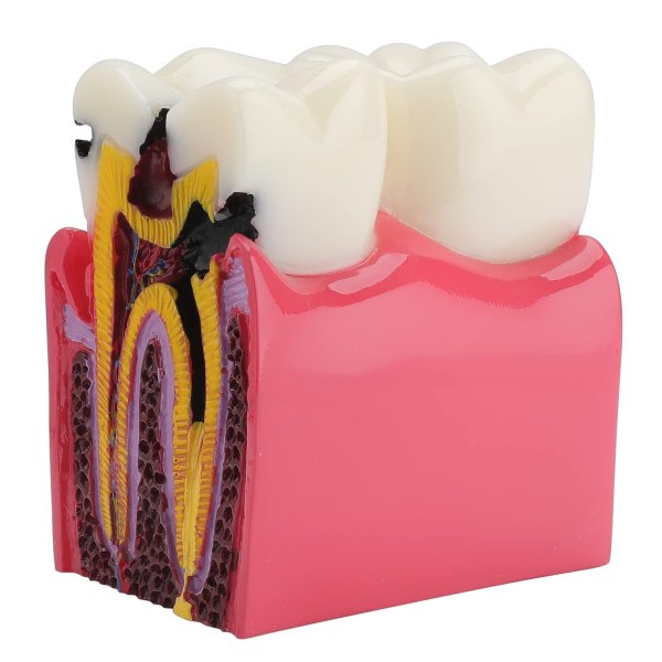 Hammaskarieksen hammasmalli - 6 kertaa karies Anatomia Hampaidenhoito Hampaiden malli Karieshampaat Vertaileva koulutus Malli Hammasmalli Te