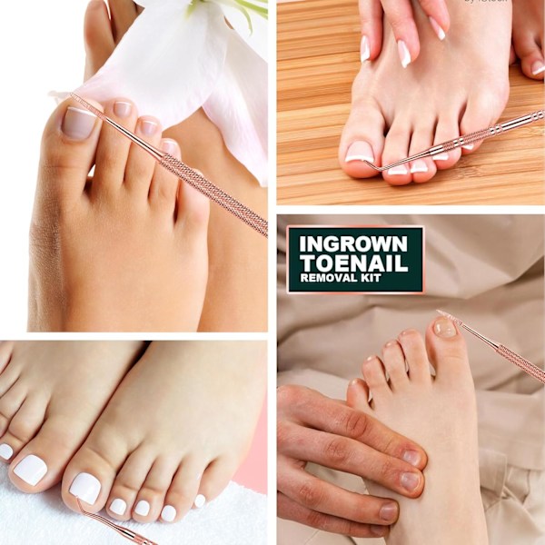 3 st Rose Gold Ingrodda Naglar Verktyg, Nagelfil och Lyftverktyg, Professionell Kirurgisk Säker Ingrodda Naglar Behandling Ped