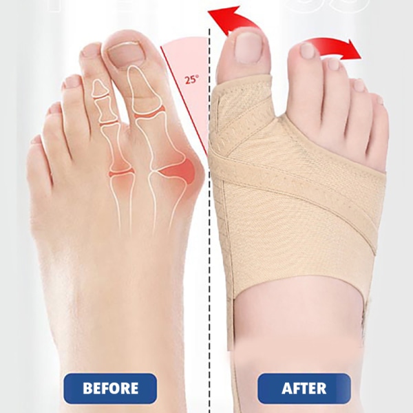 Toe Valgus Correction Device suojaava hiha jalkojen etutyynyt L