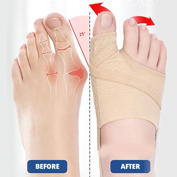 Toe Valgus Correction Device suojaava hiha jalkojen etutyynyt S