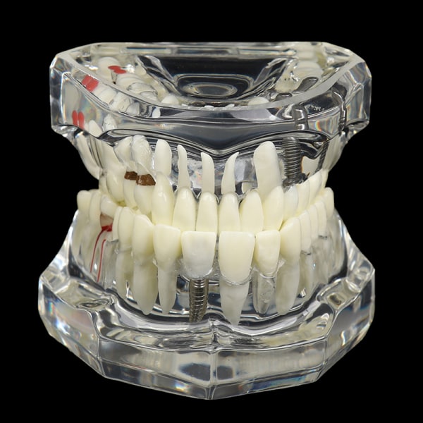Dental Model Im Restoration Bridge for Study Tooth Science