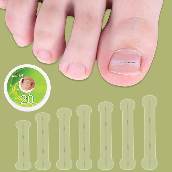 10 stk indgroede tånegl korrektion Behandling Clip Brace Pedicure 18MM