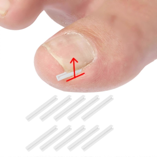 10 st Ingrodda Tånagelskorrigeringsremsor Nagelspårskydd Återhämtningsklämmor Kvinnor