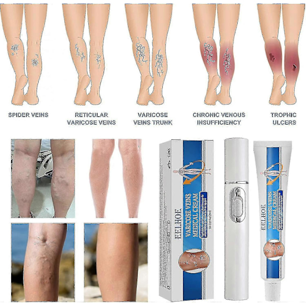Veins Health Åderbråck Blått Ljus Behandlingskit, 1 st Laserbehandlingspenna