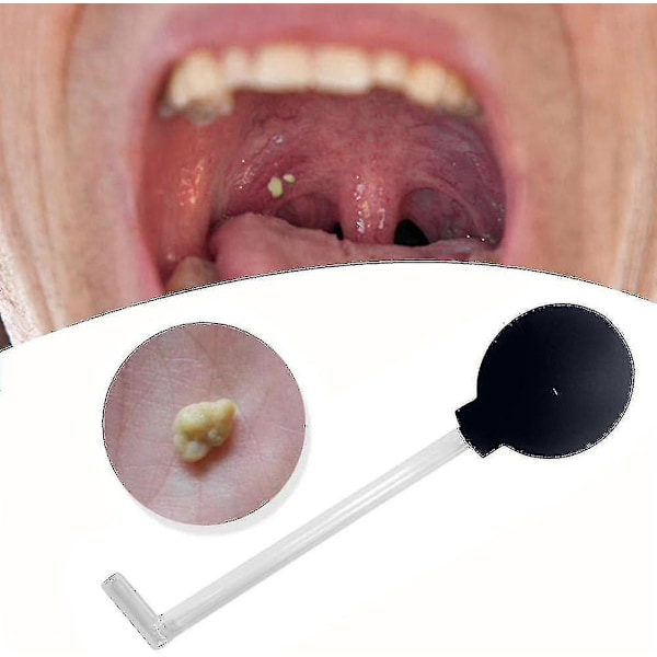 Mandelstenborttagare med Vakuum, Mandelstenborttagningsset Verktyg Mandelstenbehandling Oral Sugverktyg, Tandsuga Munnrengöring Oral