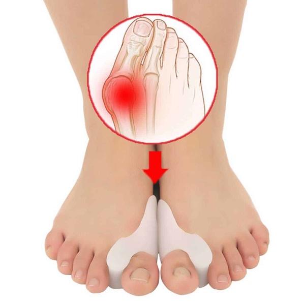 Hallux Vulgus -suojaus - TOE -levitin 2 kpl suuret valkoinen