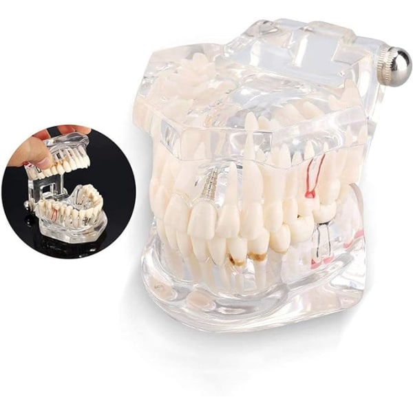 Patologisk Vuxen Transparent Tand Modell Tandläkare Oral